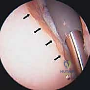 صورة توضيحية لـ جراحة تنظير المفصل لترميم الكتف وعلاج خشونة المفصل الكتفي العضدي: دليل شامل للمرضى