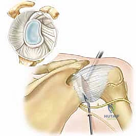 تنعيم الغضروف وإزالة النتوءات العظمية بالمنظار