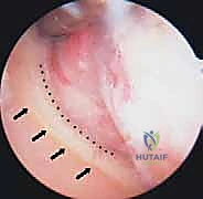 صورة توضيحية لـ جراحة تنظير المفصل لترميم الكتف وعلاج خشونة المفصل الكتفي العضدي: دليل شامل للمرضى