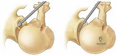 صورة توضيحية لـ جراحة تنظير المفصل لترميم الكتف وعلاج خشونة المفصل الكتفي العضدي: دليل شامل للمرضى