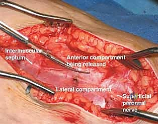 التحضير للتدخل الجراحي الطارئ لبضع اللفافة