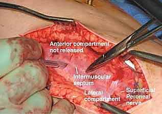 تأثير الضغط الخارجي والجبائر الضيقة على الساق
