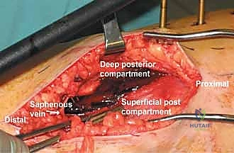صورة توضيحية لـ متلازمة الحيز الحادة في الساق: دليل شامل لجراحة بضع اللفافة مع الأستاذ الدكتور محمد هطيف