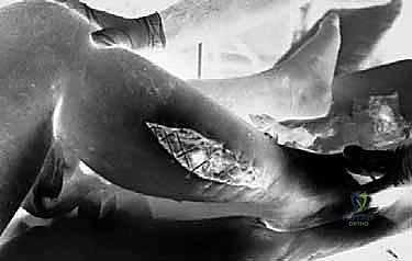 صورة توضيحية لـ متلازمة الحيز الحادة في الساق: دليل شامل لجراحة بضع اللفافة مع الأستاذ الدكتور محمد هطيف