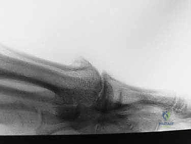 إبهام القدم المتصلب: عملية موبيرج وشايليكتومي لاستعادة الحركة والتخلص من الألم مع الأستاذ الدكتور محمد هطيف في صنعاء