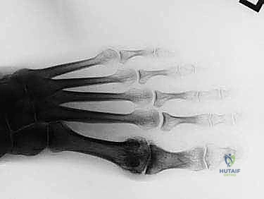 النتيجة النهائية وإغلاق الجرح