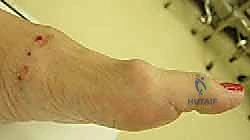 الميكانيكا الحيوية لعملية موبيرج لقطع العظم