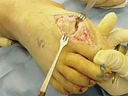 خطوات عملية شايليكتومي لإزالة النتوء العظمي