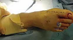 التخطيط الجراحي والأشعة السينية لإبهام القدم المتصلب