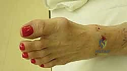 تأثير النتوءات العظمية على حركة المفصل