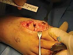 الشق الجراحي وكشف المفصل