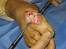 إزالة النتوء العظمي وتنعيم المفصل