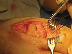 صورة توضيحية لـ إبهام القدم المتصلب: عملية موبيرج وشايليكتومي لاستعادة الحركة والتخلص من الألم مع الأستاذ الدكتور محمد هطيف في صنعاء