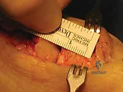 إجراء القطع العظمي الإسفيني - موبيرج