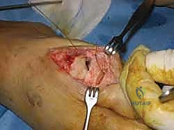 تثبيت العظم باستخدام برغي تيتانيوم دقيق