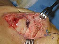 Moberg Osteotomy & Cheilectomy: A Masterclass in Hallux Rigidus Correction