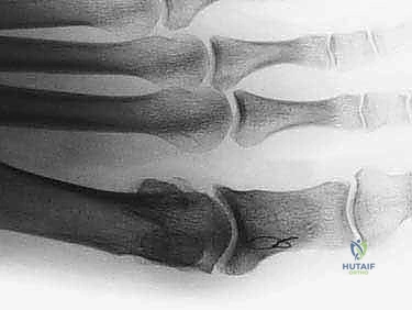 صورة توضيحية لـ إبهام القدم المتصلب: عملية موبيرج وشايليكتومي لاستعادة الحركة والتخلص من الألم مع الأستاذ الدكتور محمد هطيف في صنعاء