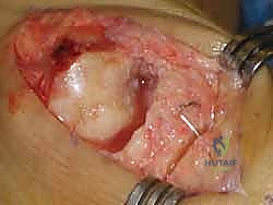 صورة توضيحية لـ إبهام القدم المتصلب: عملية موبيرج وشايليكتومي لاستعادة الحركة والتخلص من الألم مع الأستاذ الدكتور محمد هطيف في صنعاء