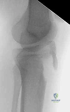 خطوات الرد المفتوح والتثبيت الداخلي لكسر حدبة الظنبوب