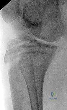 كسر حدبة الظنبوب: دليل شامل لعلاج الرد المفتوح والتثبيت الداخلي مع الأستاذ الدكتور محمد هطيف في صنعاء