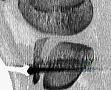 تصنيف كسور حدبة الظنبوب وأنواعها