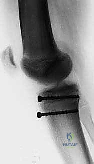 Masterclass: Open Reduction and Internal Fixation of Tibial Tuberosity Fractures