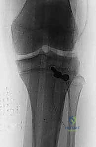 ميكانيكية حدوث كسر حدبة الظنبوب