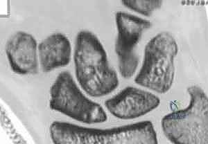 التشخيص الدقيق لكسور العظم الزورقي باستخدام الأشعة والمناظير