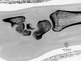 التخطيط الجراحي لكسر العظم الزورقي قبل العملية
