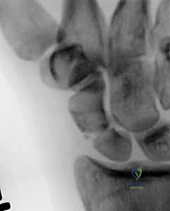 Illustration of fixation of scaphoid - Dr. Mohammed Hutaif