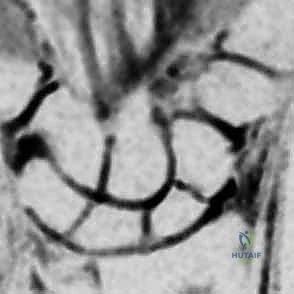 تحديد موقع الألم في منطقة منشقة الشم التشريحية