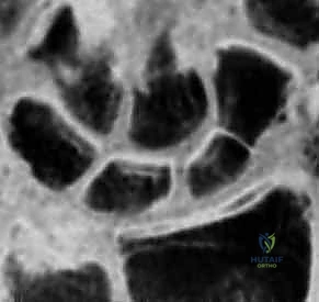 التحضير لعملية الرد المفتوح والتثبيت الداخلي للزورقي