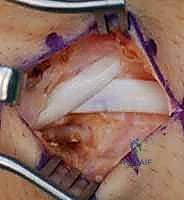 تنظيف موقع الكسر ورد العظم الزورقي إلى وضعه التشريحي