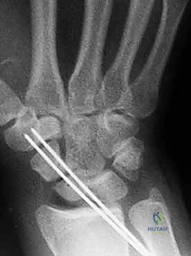 مضاعفات عدم التئام العظم الزورقي وتآكل مفصل الرسغ