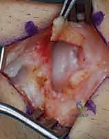 استخدام الأدوات الدقيقة لرد الكسر في الرسغ