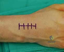 النهج الجراحي والشق الطبي للوصول إلى العظم الزورقي