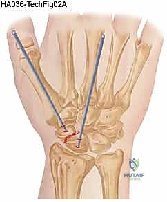 العلاج الطبيعي وتأهيل مفصل الرسغ بعد جراحة العظم الزورقي