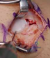 التثبيت النهائي لكسر العظم الزورقي ببرغي ضغط بدون رأس