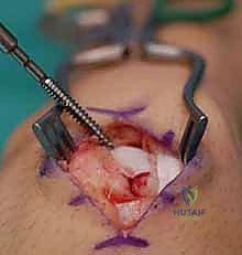 استعادة وظيفة الرسغ بالكامل بعد جراحة ناجحة مع الدكتور محمد هطيف