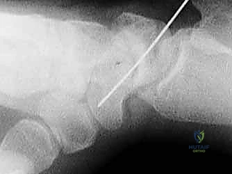 جراحة كسر العظم الزورقي بالرد المفتوح والتثبيت الداخلي: خبرة الأستاذ الدكتور محمد هطيف في صنعاء