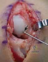 آلية السقوط على اليد الممدودة المسببة لكسر العظم الزورقي