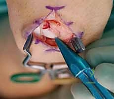 النخر اللاوعائي في العظم الزورقي نتيجة نقص التروية الدموية