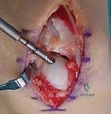 إدخال برغي التثبيت الداخلي في العظم الزورقي