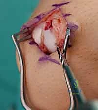 الأستاذ الدكتور محمد هطيف أثناء إجراء جراحة دقيقة في صنعاء