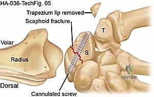 استخدام الرقعة العظمية لعلاج عدم التئام العظم الزورقي