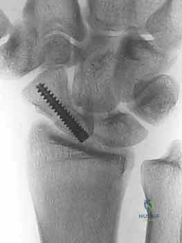 تأكيد وضع التثبيت الداخلي باستخدام الأشعة السينية أثناء الجراحة