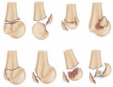 تشخيص كسور الجزء الداني من عظم العضد مع الأستاذ الدكتور محمد هطيف