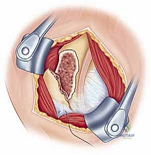 الأشعة السينية المقطعية لتشخيص الكسور المعقدة