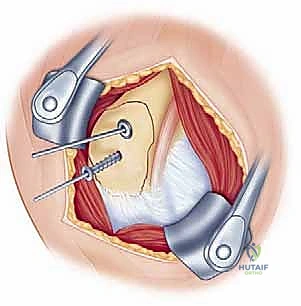 استبدال مفصل الكتف كخيار علاجي للكسور المفتتة