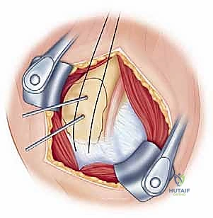 التثبيت الداخلي باستخدام الشرائح والمسامير